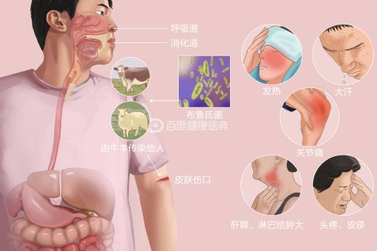 布鲁氏菌病
