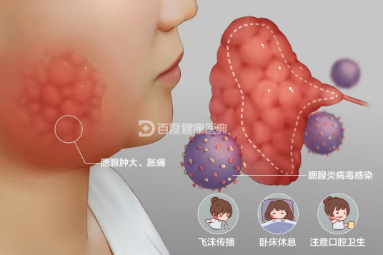 流行性腮腺炎