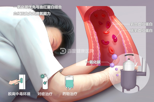 一氧化碳中毒