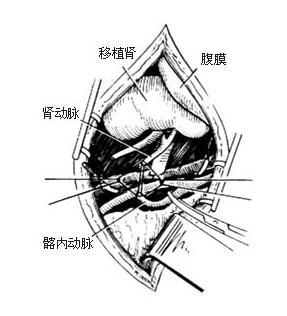 肾周围炎