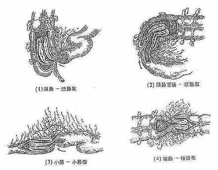 儿童腹痛