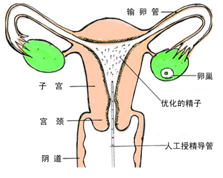 人工受精