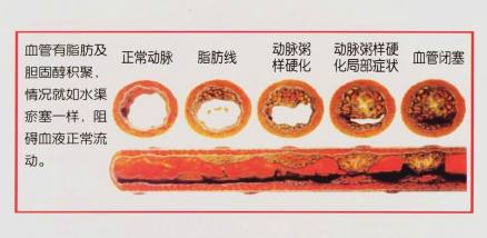 动脉粥样硬化示意图