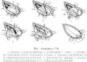 成人腹股沟斜疝(三)