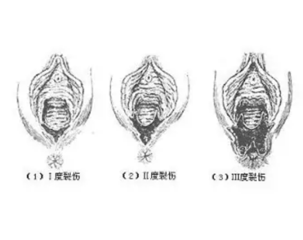 软产道裂伤示意图