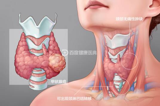 甲状腺癌