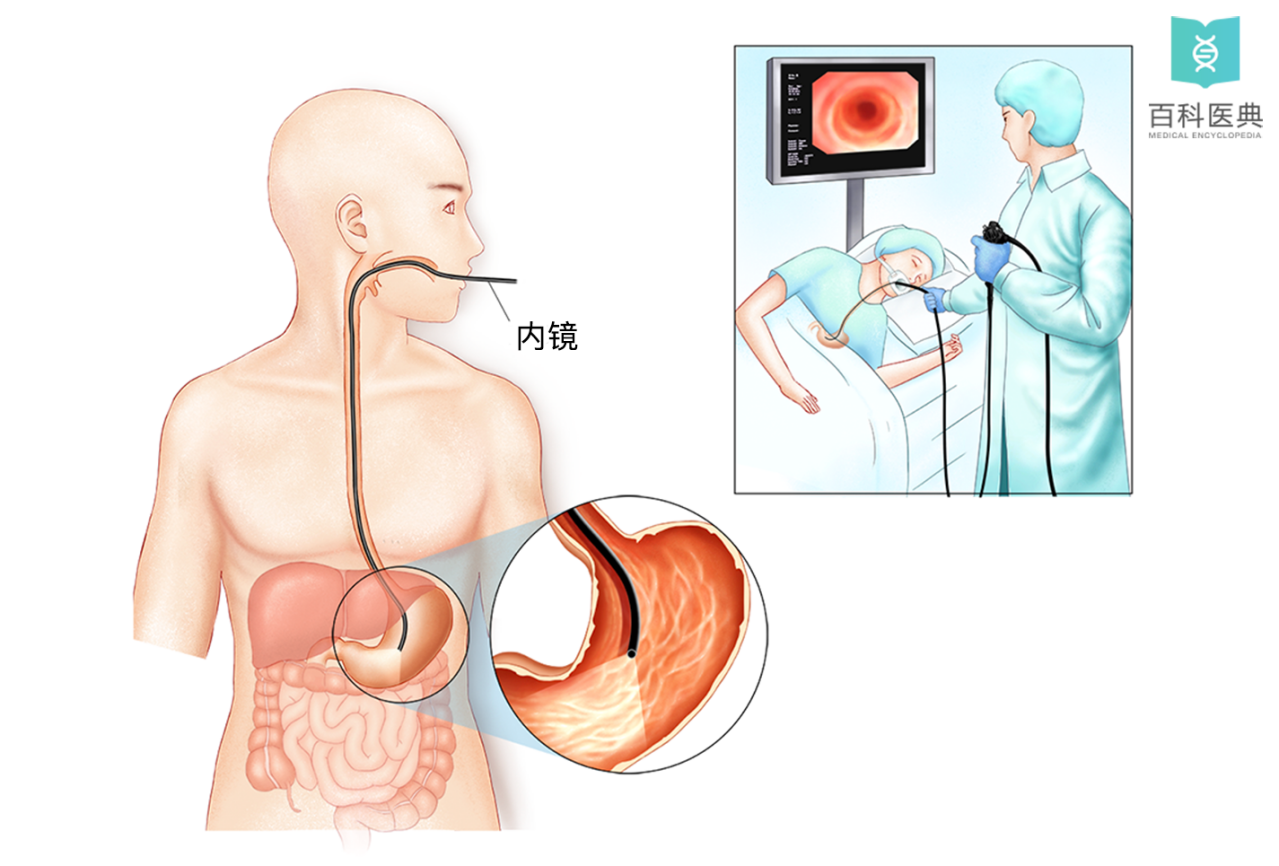 内镜检查