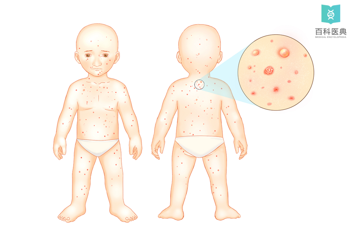 水痘的症状