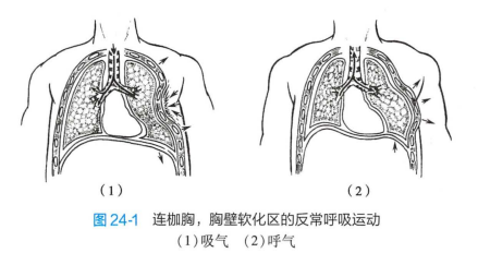 连枷胸 