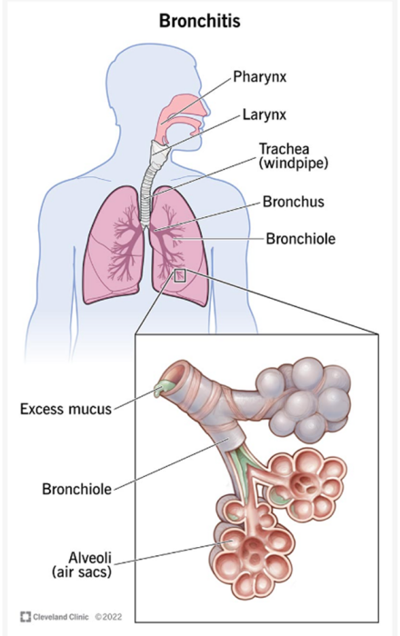 Bronchitis