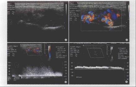 面颊部蔓状血管瘤超声表现