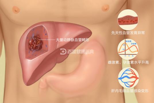 肝血管瘤