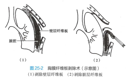 胸膜纤维板剥脱术 