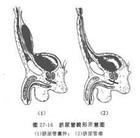 脐尿管囊肿及脐尿管瘘