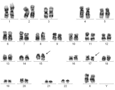 46,XX,t(15