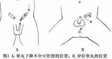 小儿隐睾症