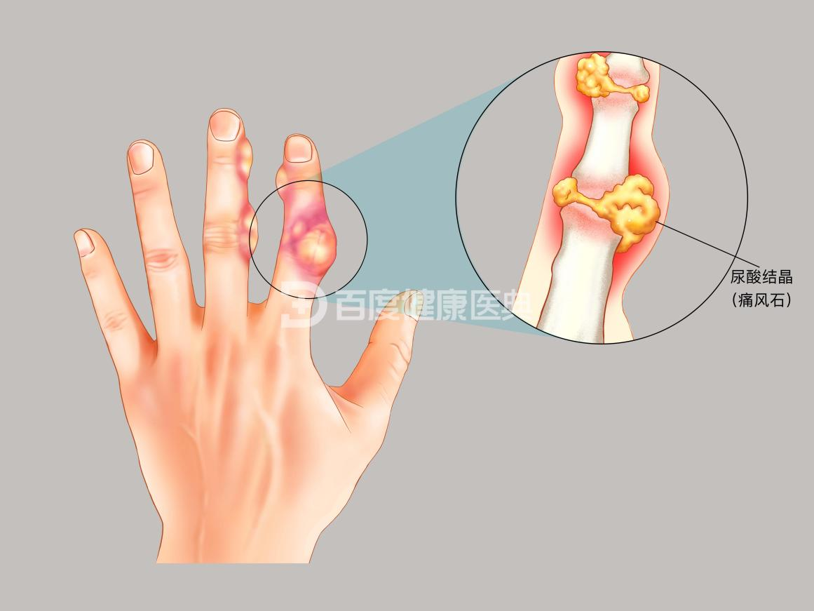 痛风的典型症状