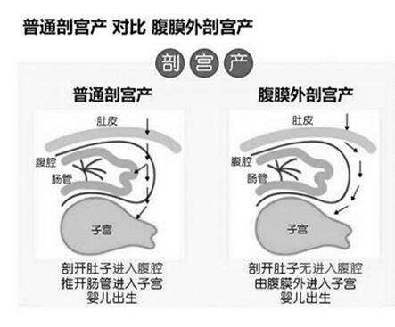 腹膜外剖宫产术