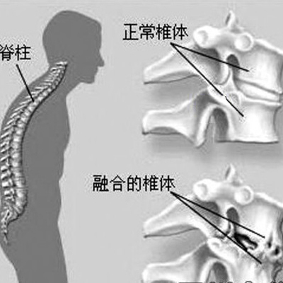 强直性脊柱炎