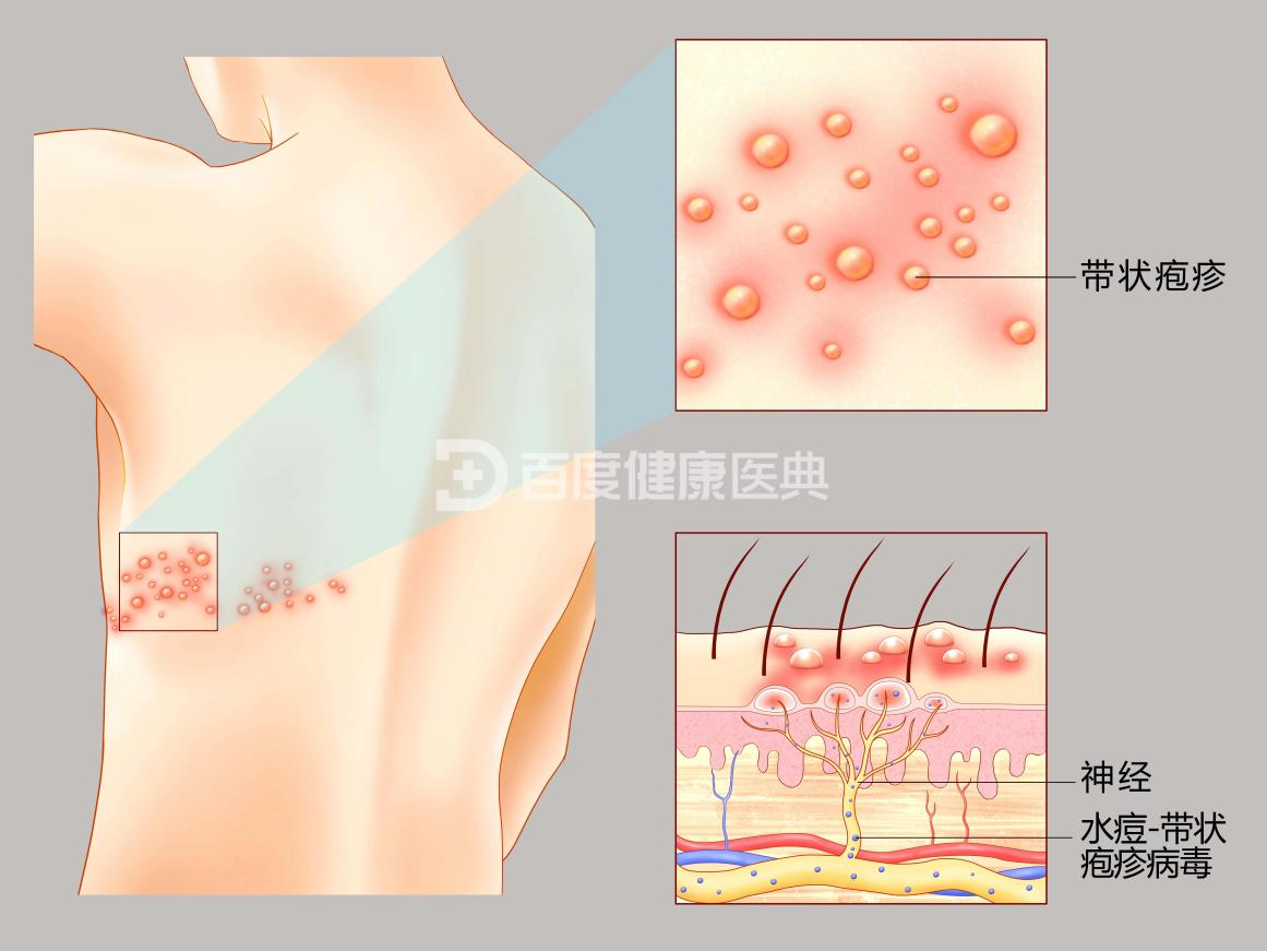 带状疱疹的症状