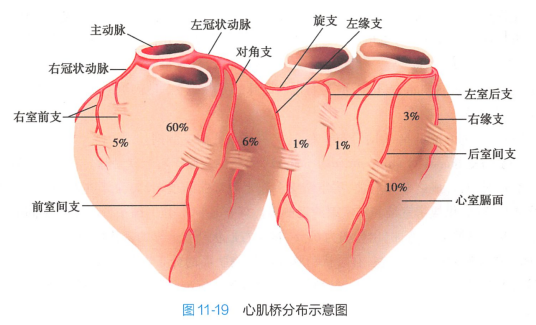 心肌桥