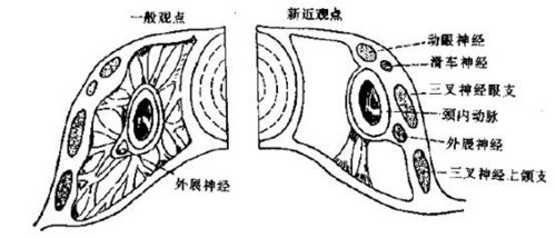 动眼神经麻痹