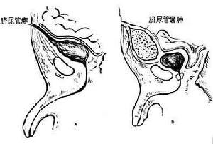 脐尿管囊肿及脐尿管瘘