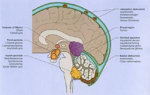 脑水肿