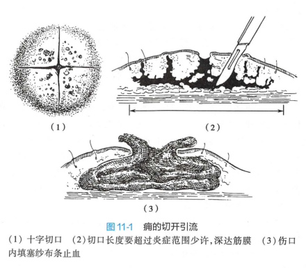 痈的切开引流 