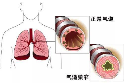 气管、支气管狭窄