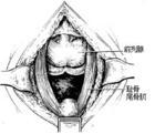 耻骨直肠肌综合征