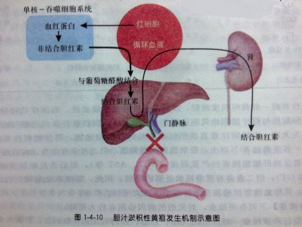 阻塞性黄疸发病机制