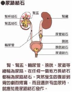 尿路结石