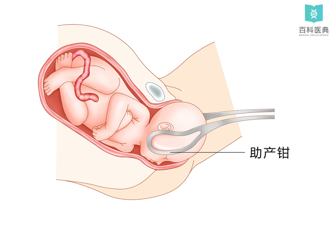 分娩时使用助产钳