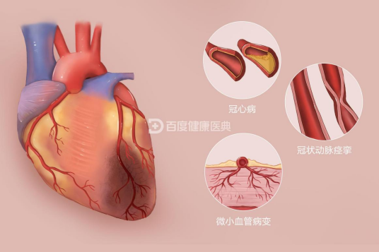 心肌缺血