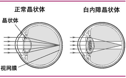 并发症白内障