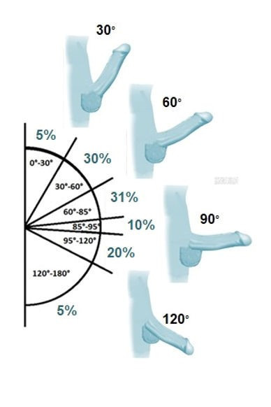 阴茎勃起角度 