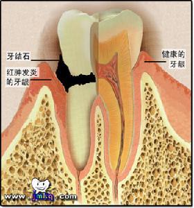 牙龈炎