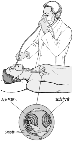 支气管镜检示意图