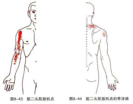 肱二头肌的扳机点 