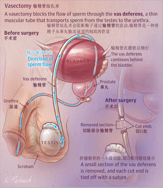 图 6 输精管结扎示意图 