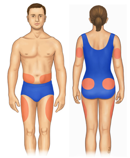 胰岛素的注射部位
